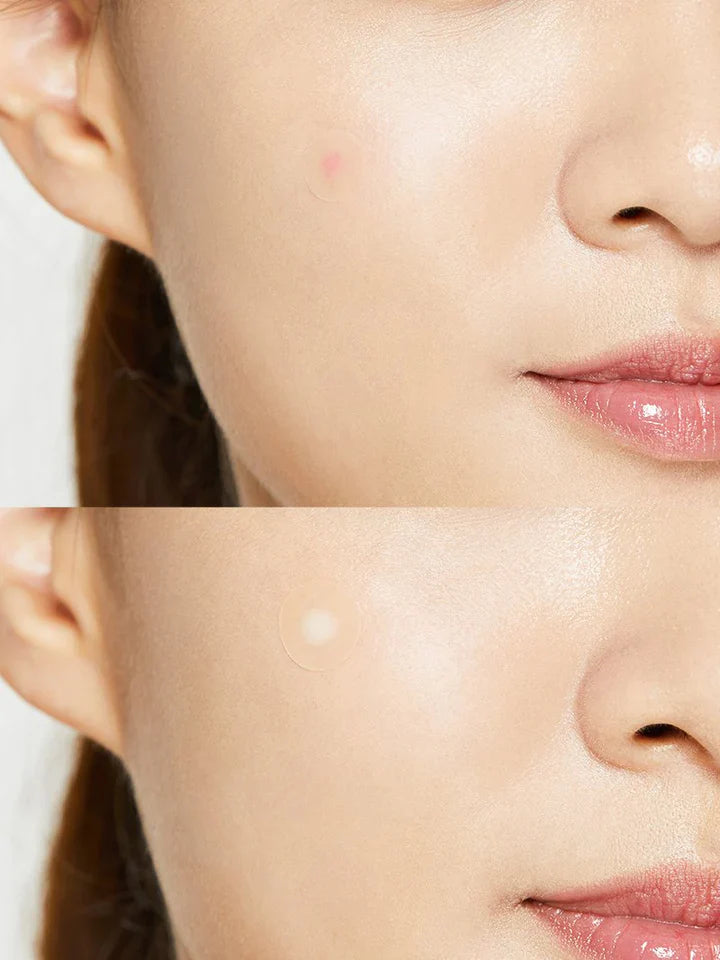 Пачове за пъпки Cosrx Acne Pimple Master Patch